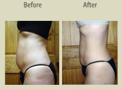 Before & After Photo