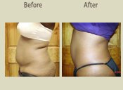 Before & After Photo