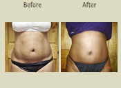Before & After Photo