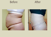 Before & After Photo