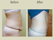 Before & After Photo