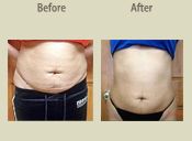 Before & After Photo