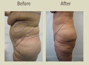 Before & After Photo