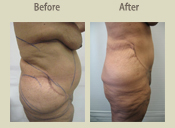 Before & After Photo