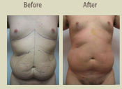 Before & After Photo