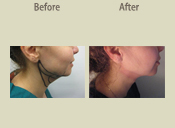 Before & After Photo