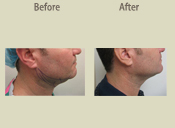 Before & After Photo