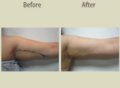 Before & After Photo