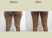 Before & After Photo