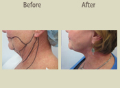 Before & After Photo