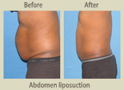 Before & After Photo