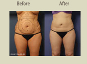 Before & After Photo