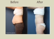 Before & After Photo