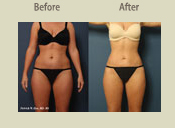 Before & After Photo