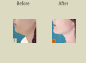 Before & After Photo