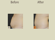 Before & After Photo