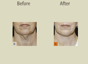 Before & After Photo