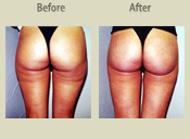 Before & After Photo