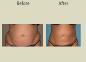 Before & After Photo