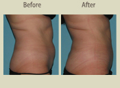 Before & After Photo