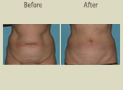 Before & After Photo