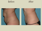 Before & After Photo