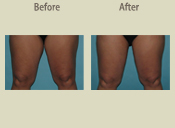 Before & After Photo