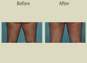 Before & After Photo