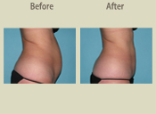 Before & After Photo