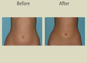 Before & After Photo