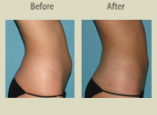 Before & After Photo