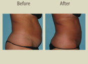 Before & After Photo