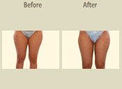 Before & After Photo