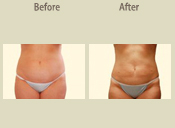 Before & After Photo