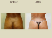 Before & After Photo