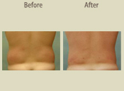 Before & After Photo