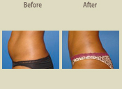 Before & After Photo