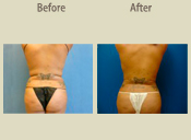 Before & After Photo