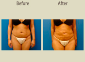 Before & After Photo