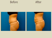 Before & After Photo