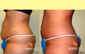 Before & After Photo