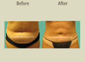 Before & After Photo