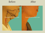 Before & After Photo