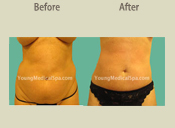 Before & After Photo