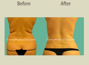 Before & After Photo
