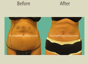 Before & After Photo