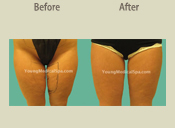 Before & After Photo