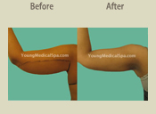 Before & After Photo