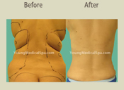 Before & After Photo