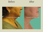 Before & After Photo